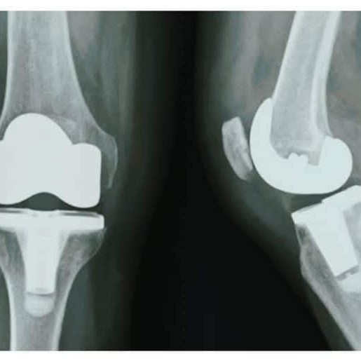 Total Knee Arthroplasty
Total knee arthroplasty (TKA) or total knee replacement treatment main image