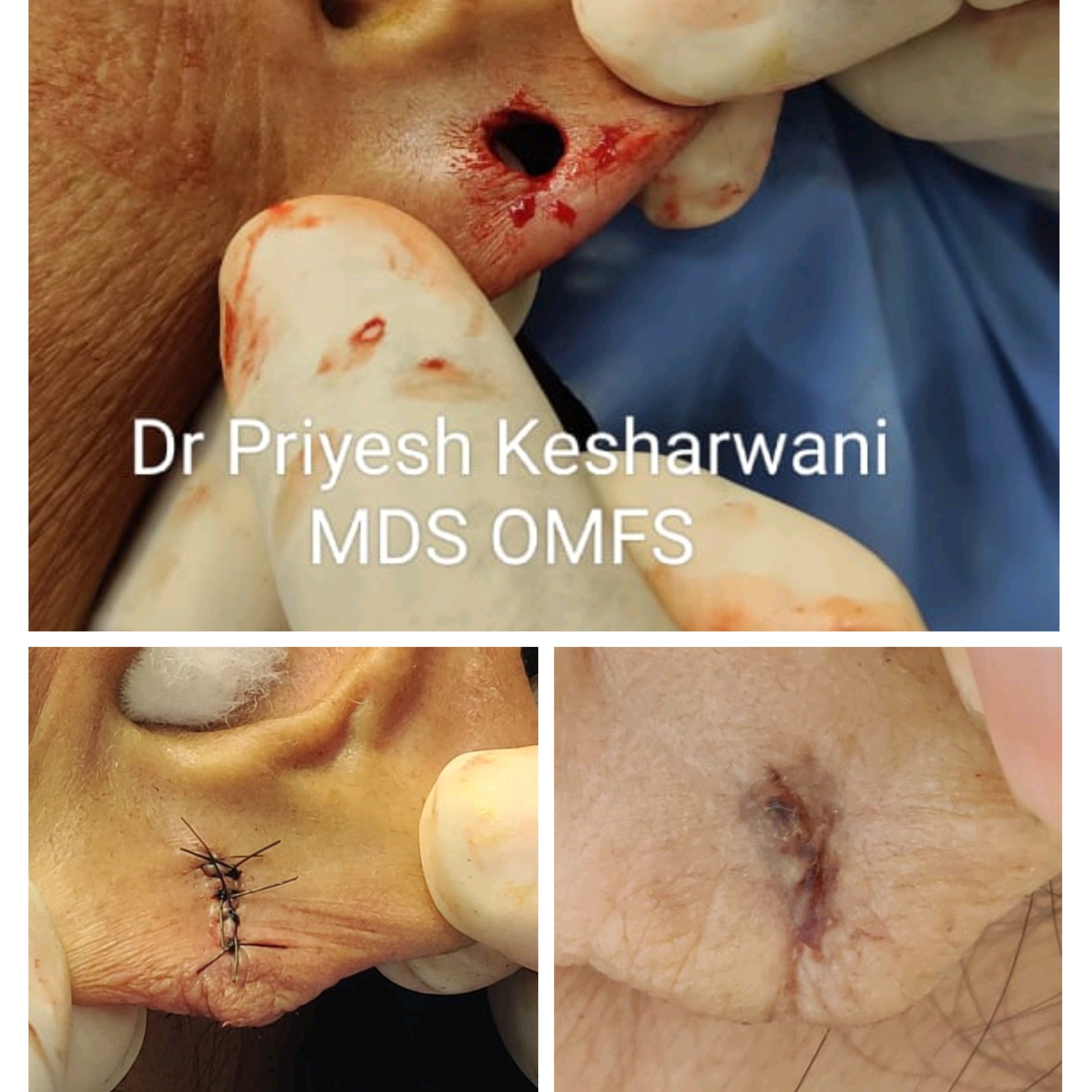 Teatment for torn/ split earlobe main image