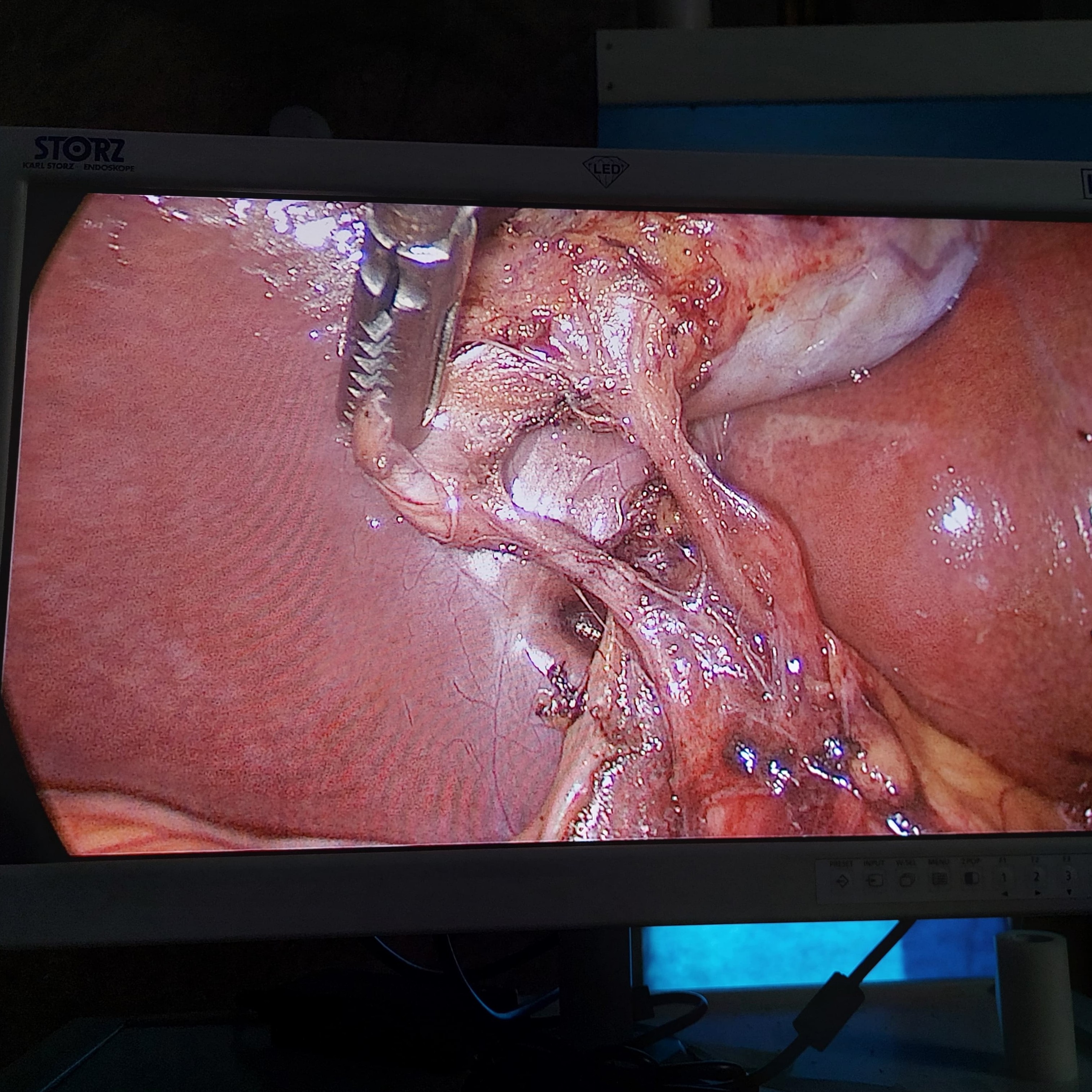Laparoscopic cholecystectomy main image