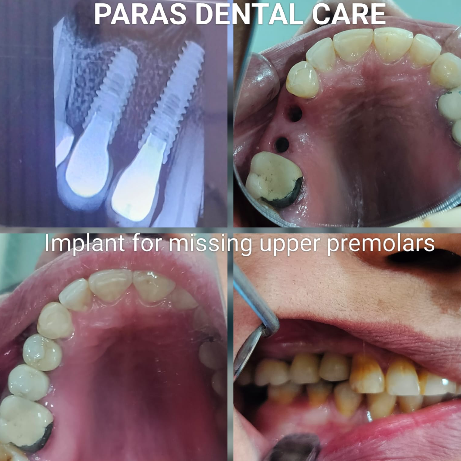 Best Dental Implant Clinic in Jaipur  main image