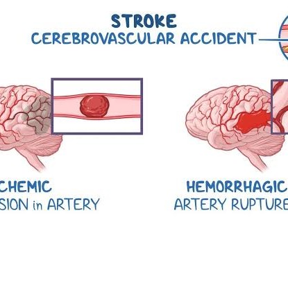 Stroke Rehabilitation with Home Physiotherapy Management at Home main image
