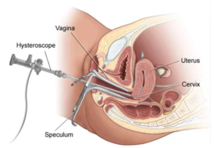 Hysteroscopic Polypectomy in Chennai – A Key Step Towards Better Reproductive Health main image