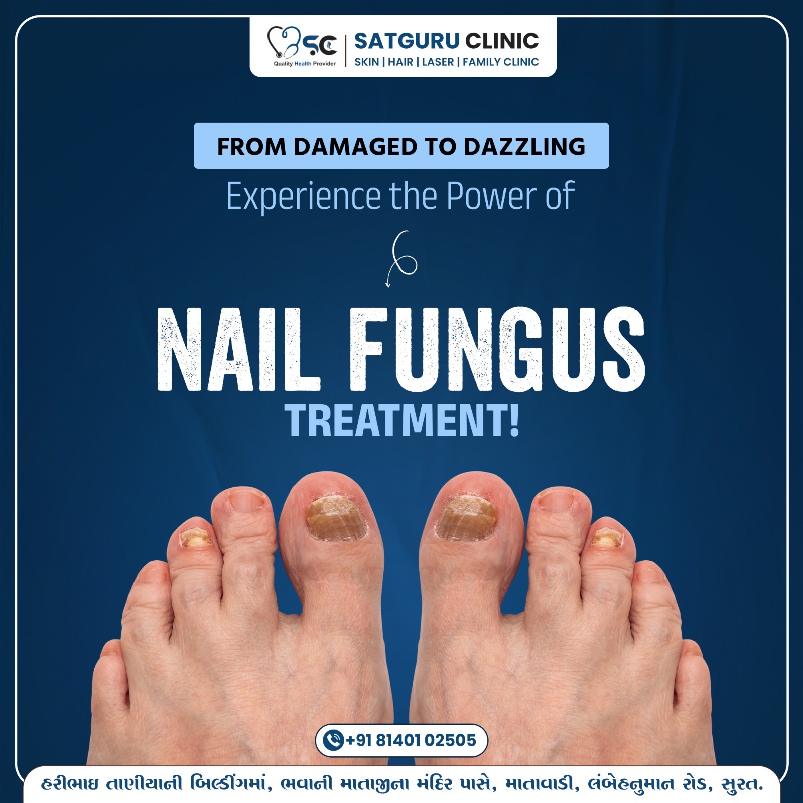 Nail fungus (onychomycosis) is a common nail infection caused by fungi, usually affecting toenails. ... main image