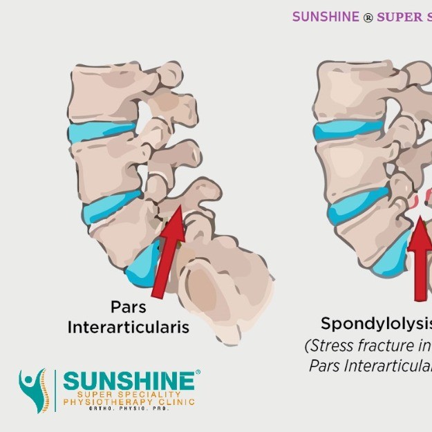 detailed description about Disc Bulge, its complications, and physiotherapy treatment at Sunshine main image
