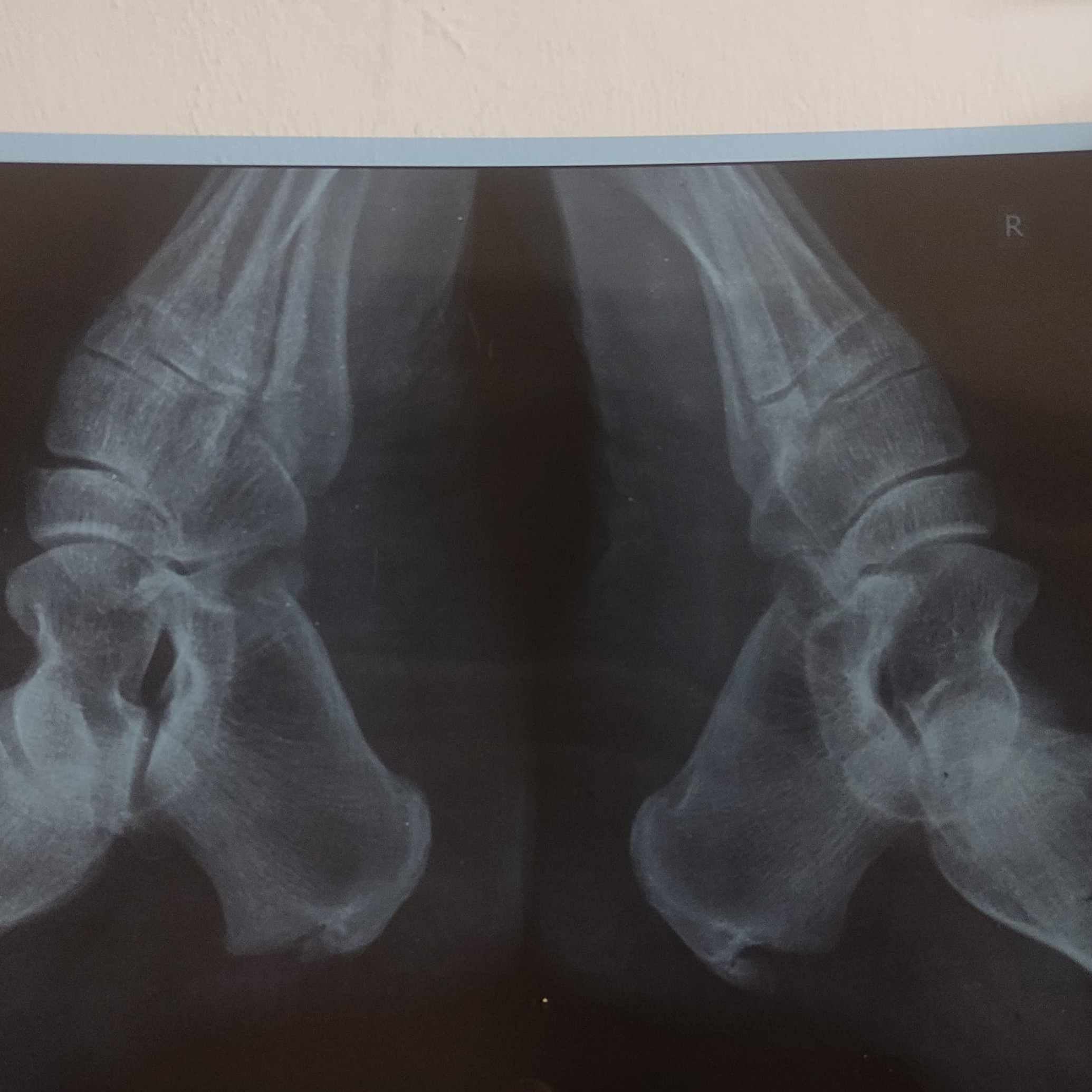 Plantar Fasciitis and its physiotherapy treatment at Sunshine Super Speciality Physiotherapy Clinic, main image