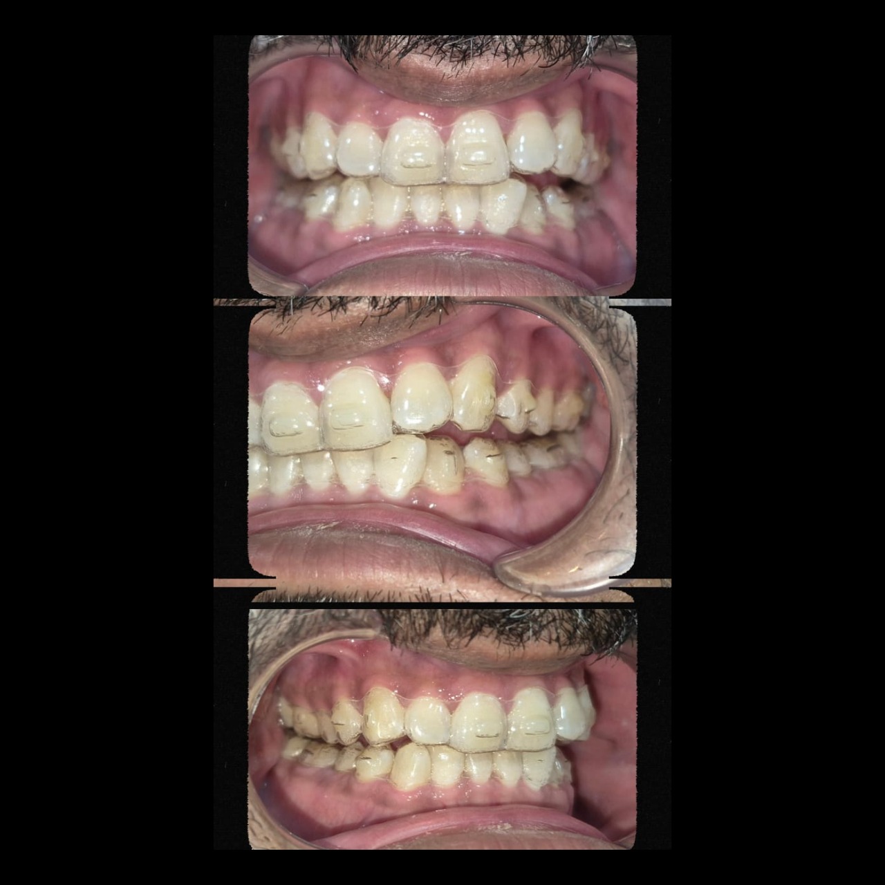 Curious about how clear aligners fit? Here’s a look! They’re designed to mold perfectly to your teet... main image