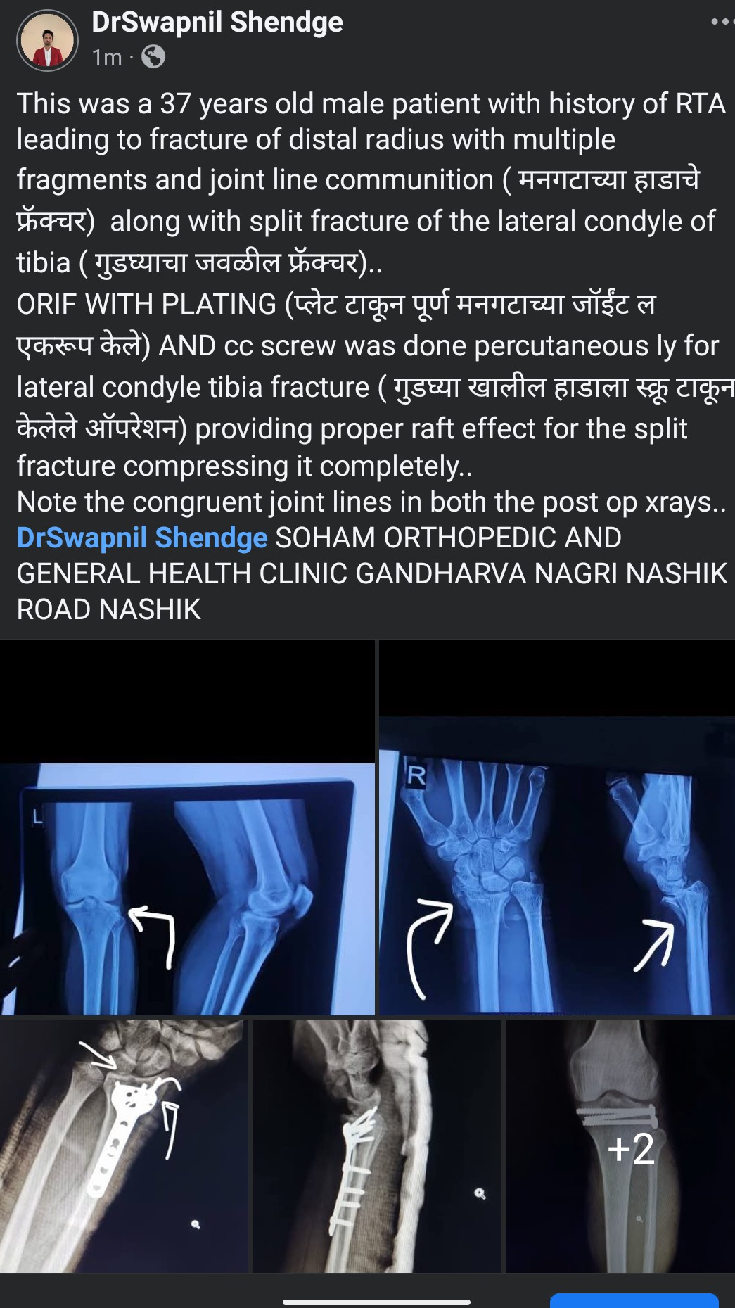Recent case operated by Dr. Swapnil Shendge.. best Orthopedician in Nashik road..  main image