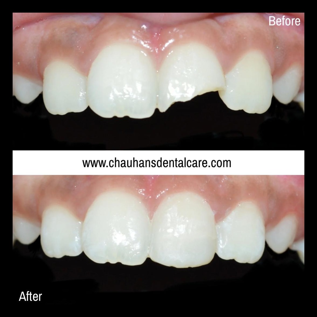 From Fracture to Flawless!
A young patient had a fall and fractured his front tooth. Thanks to our p... main image
