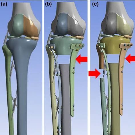 Tibial Fracture and Physiotherapy Treatment at Sunshine Super Speciality Physiotherapy Clinic main image