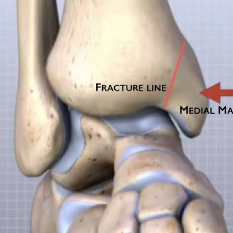 Tibial Medial Malleolus Fracture and Physiotherapy Treatment at Sunshine Super Speciality main image