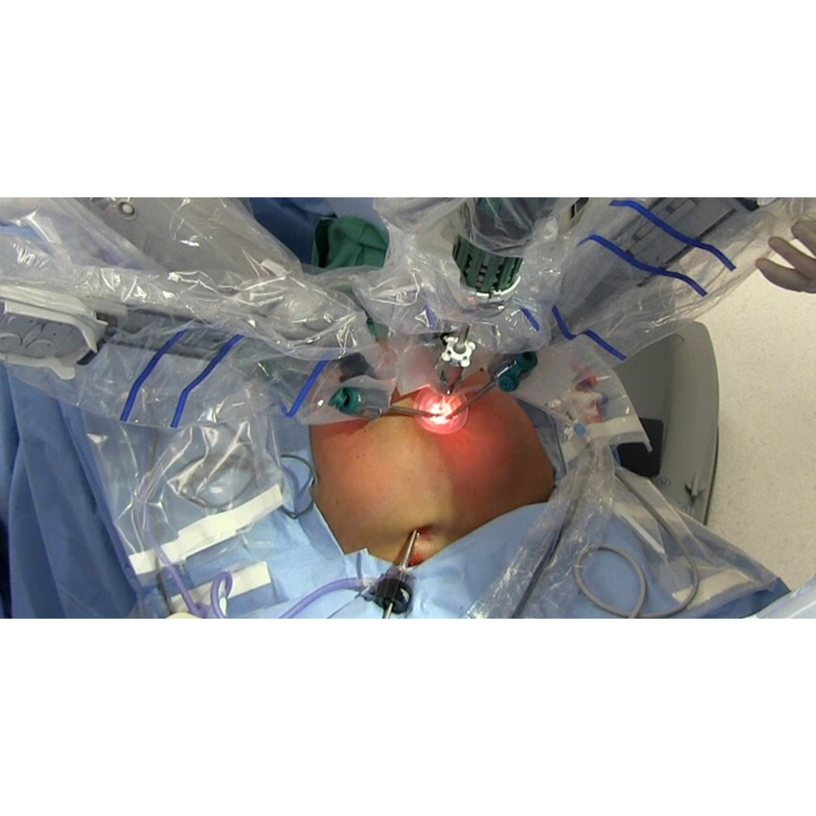 Effective GERD Relief Through Robotic Hiatus Hernia Surgery Near Dasarahalli – Trusted Care main image