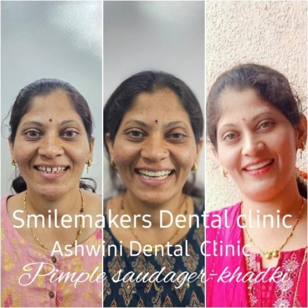 best smile makeover clinic in pimple saudagar! ✨ Age is just a number, your smile has no limits!
💯 ... main image