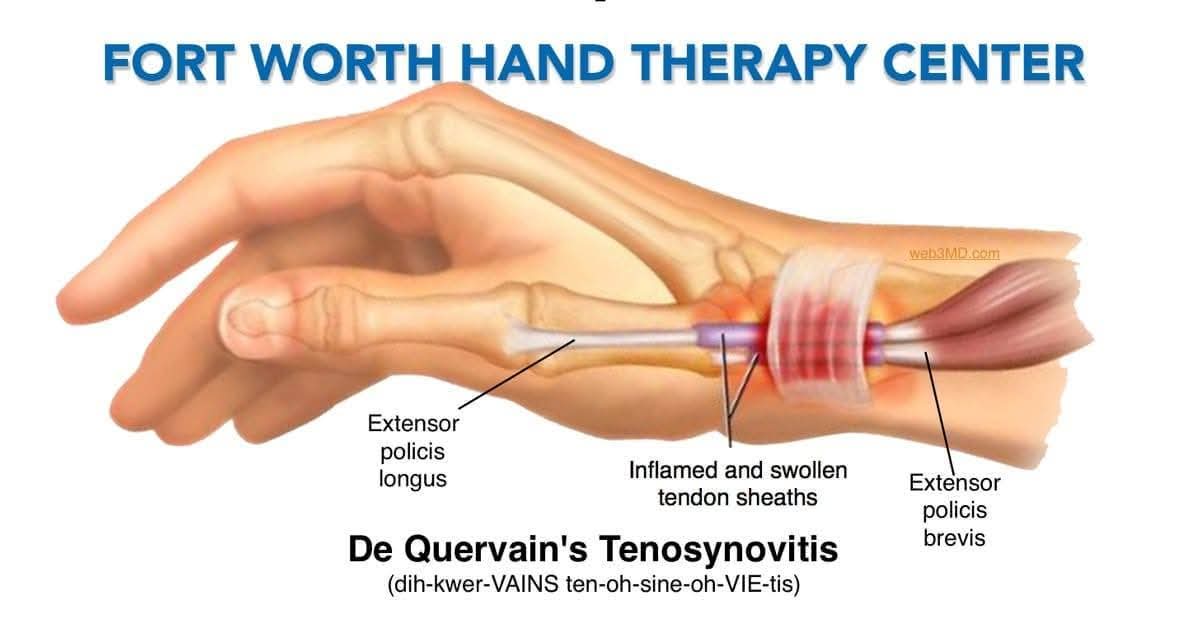 De Quervain's Syndrome
De Quervain's Tenosynovitis treatment at Sunshine clinic main image