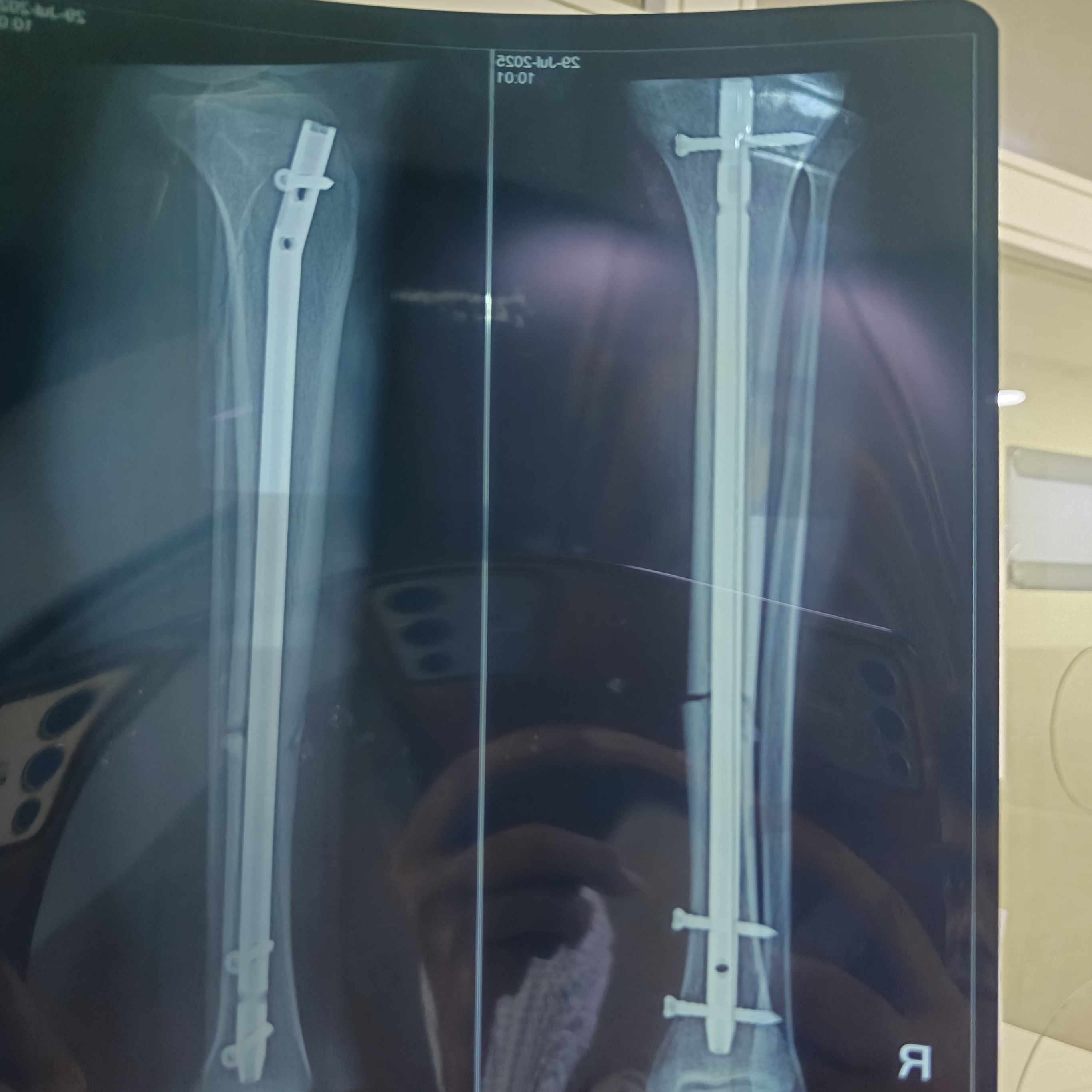 #Best sports injury specialist in Noida #Best orthopedic surgeon in Gaur City # Best ACL surgeon N... main image
