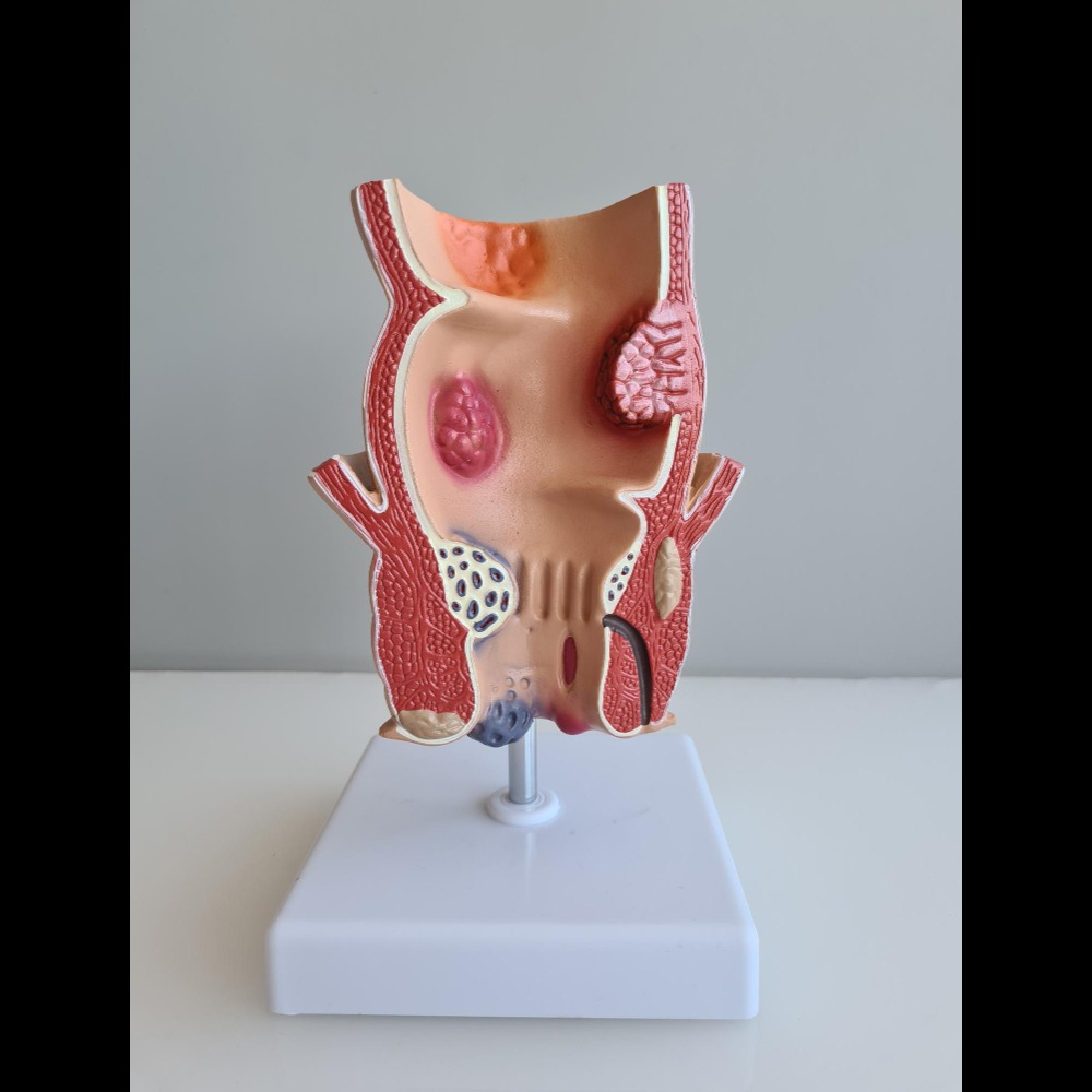 Fissure in Ano Treatment in Chennai – Comfortable Healing at S A Hospital main image