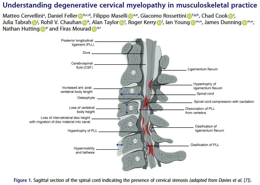 degenerative cervical myelopathy in musculoskeletal practice and treatment at Sunshine clinic main image