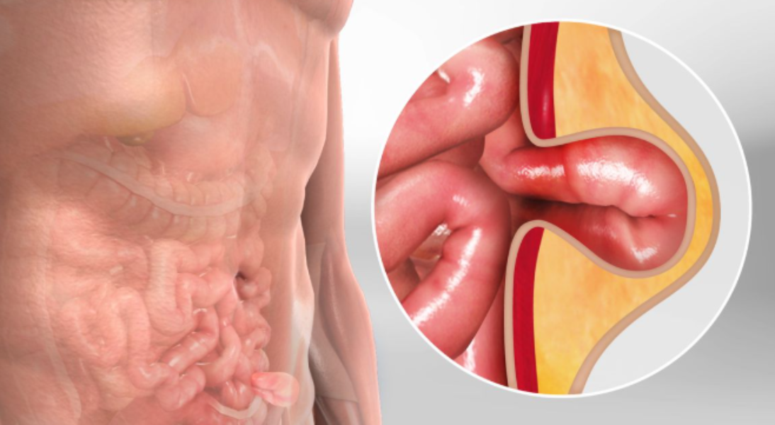 Hernia Treatment in Dombivli – Safe and Effective Surgical Repair By Dr.Tejas Savdekar main image