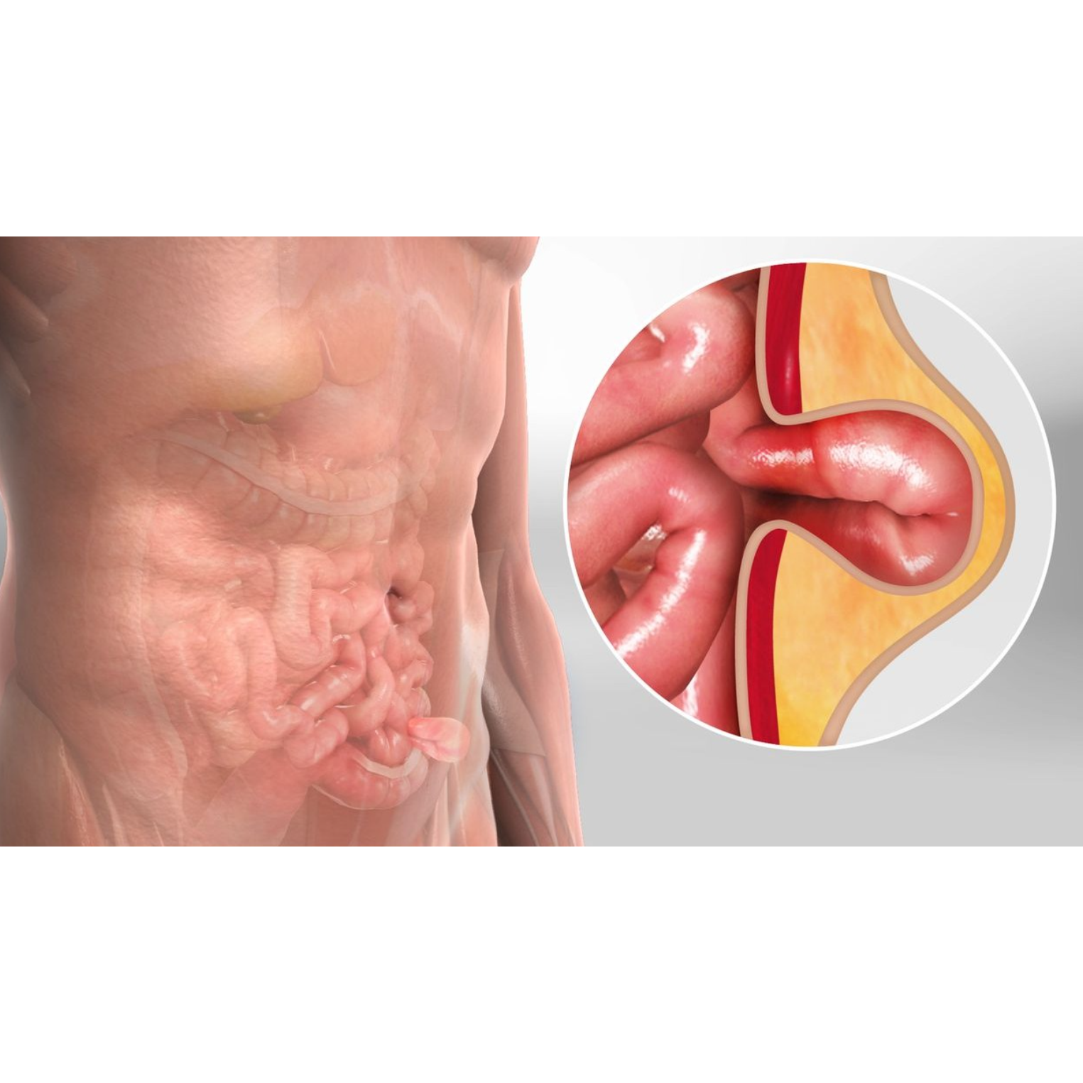 Hernia Treatment In Tharamani – Advanced Surgical and Day-Care Options main image