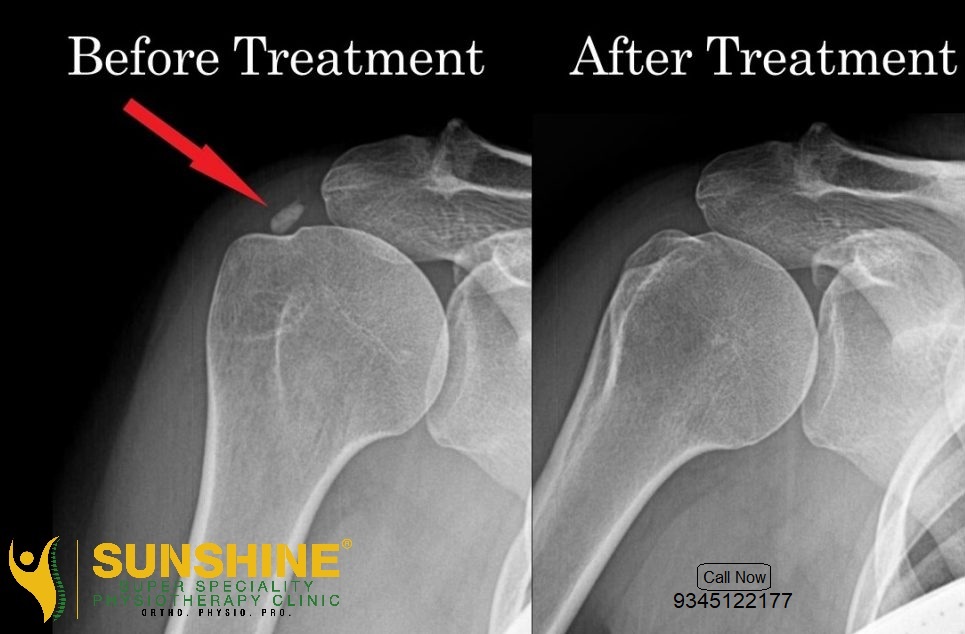 Shoulder Calcification at Sunshine Super Speciality Physiotherapy Clinic, main image