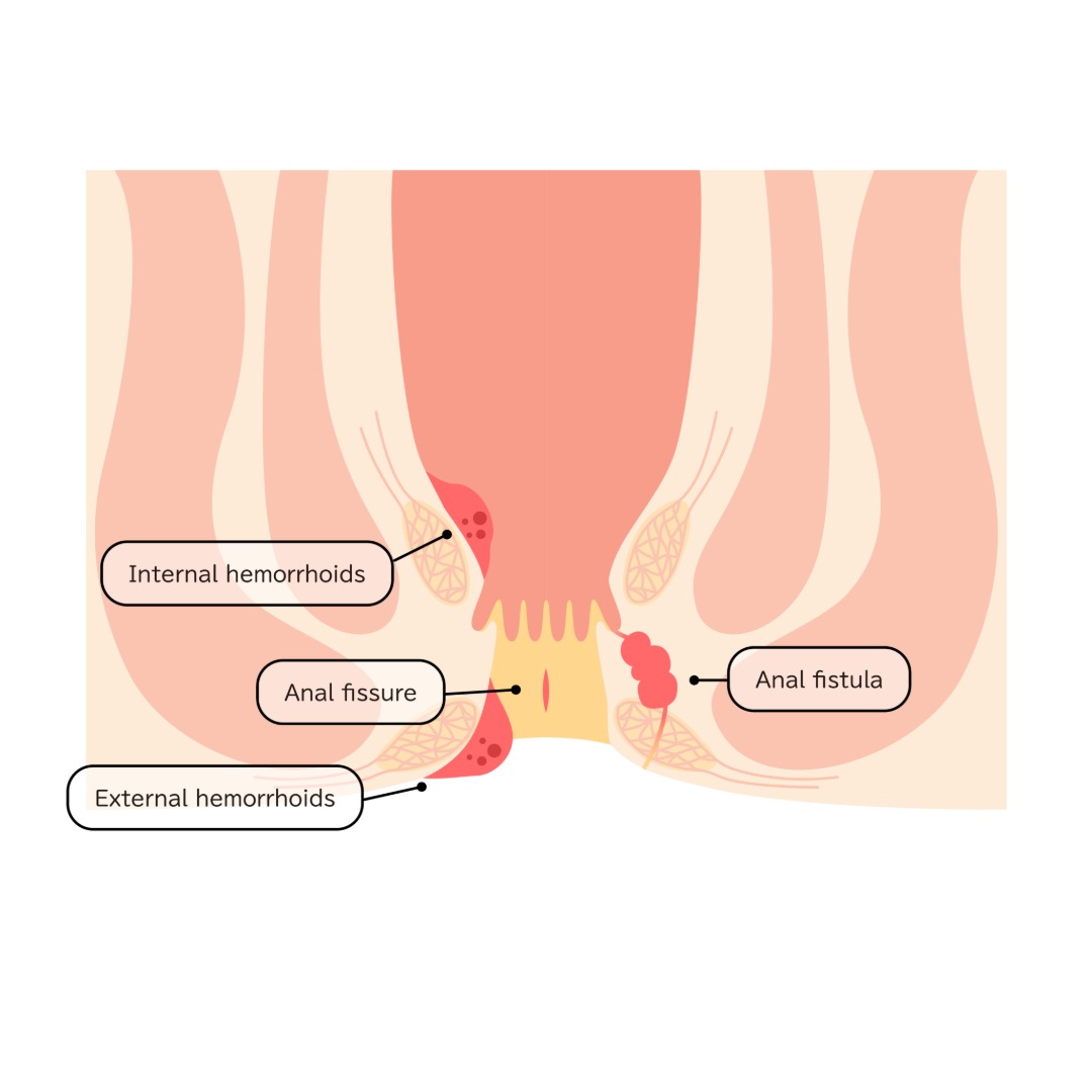 Piles Treatment main image