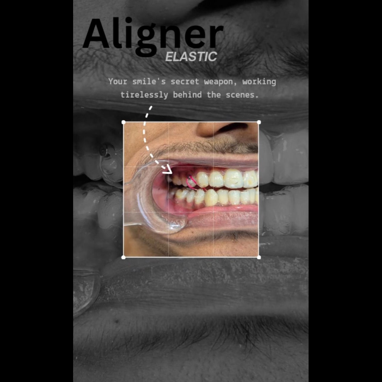 These little elastics are doing some big work! Each day brings you closer to the smile you’ve always... main image