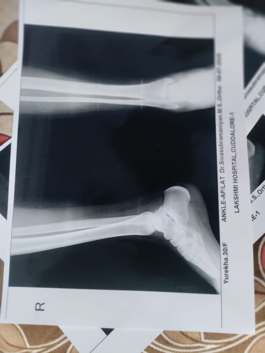 Achilles Tendon Pain Treatment at Sunshine Super Speciality Physiotherapy Clinic, Tambaram main image