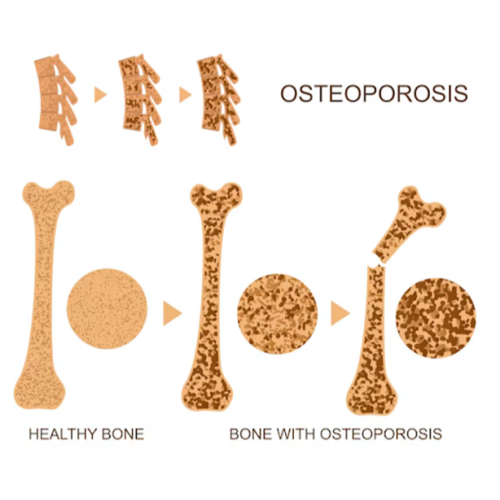 Osteoporotic Fracture Management in Nagpur – Strengthening Bones for a Safer Future main image