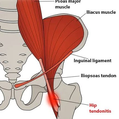 Hip Flexor Tendonitis, also known as Hip Flexor Tendinopathy main image