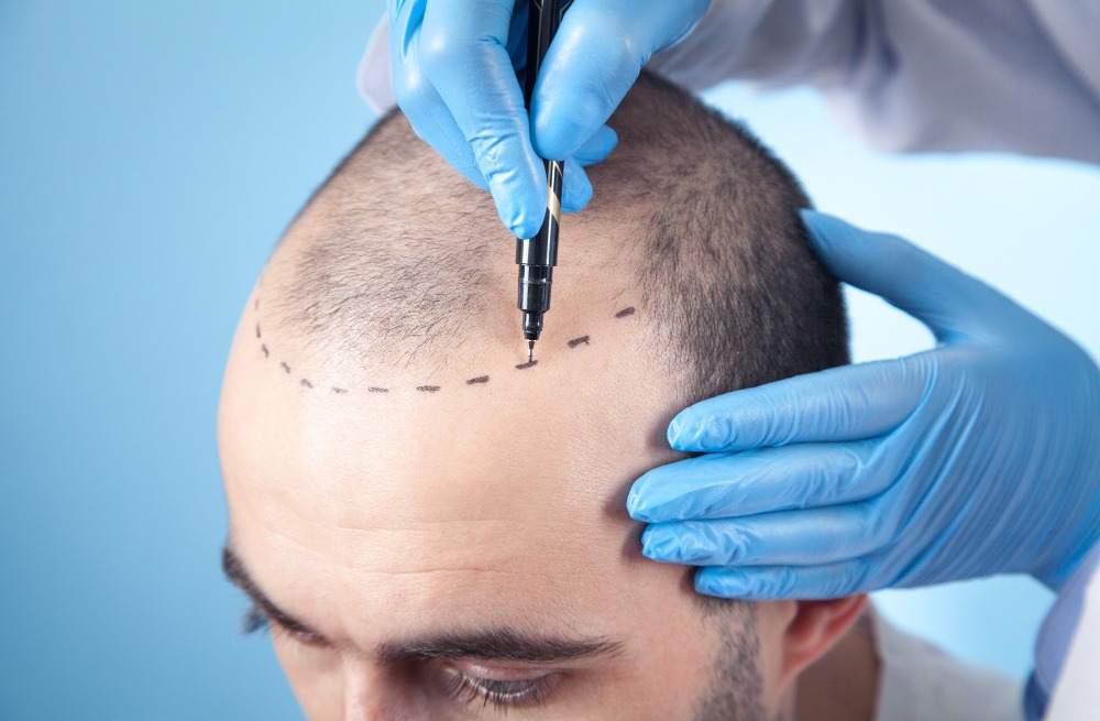 Hair Transplant for Men in Nungambakkam – Regain Your Hairline with Confidence main image