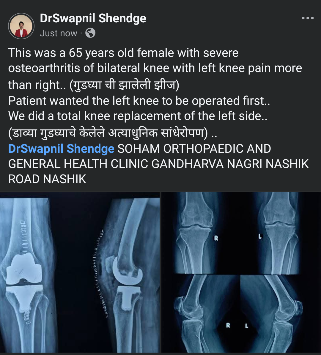 A recent knee replacement story ...  main image