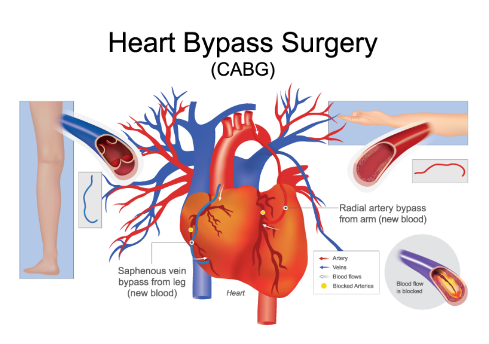 CABG SURGERY main image