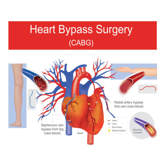 BYPASS SURGERY main image