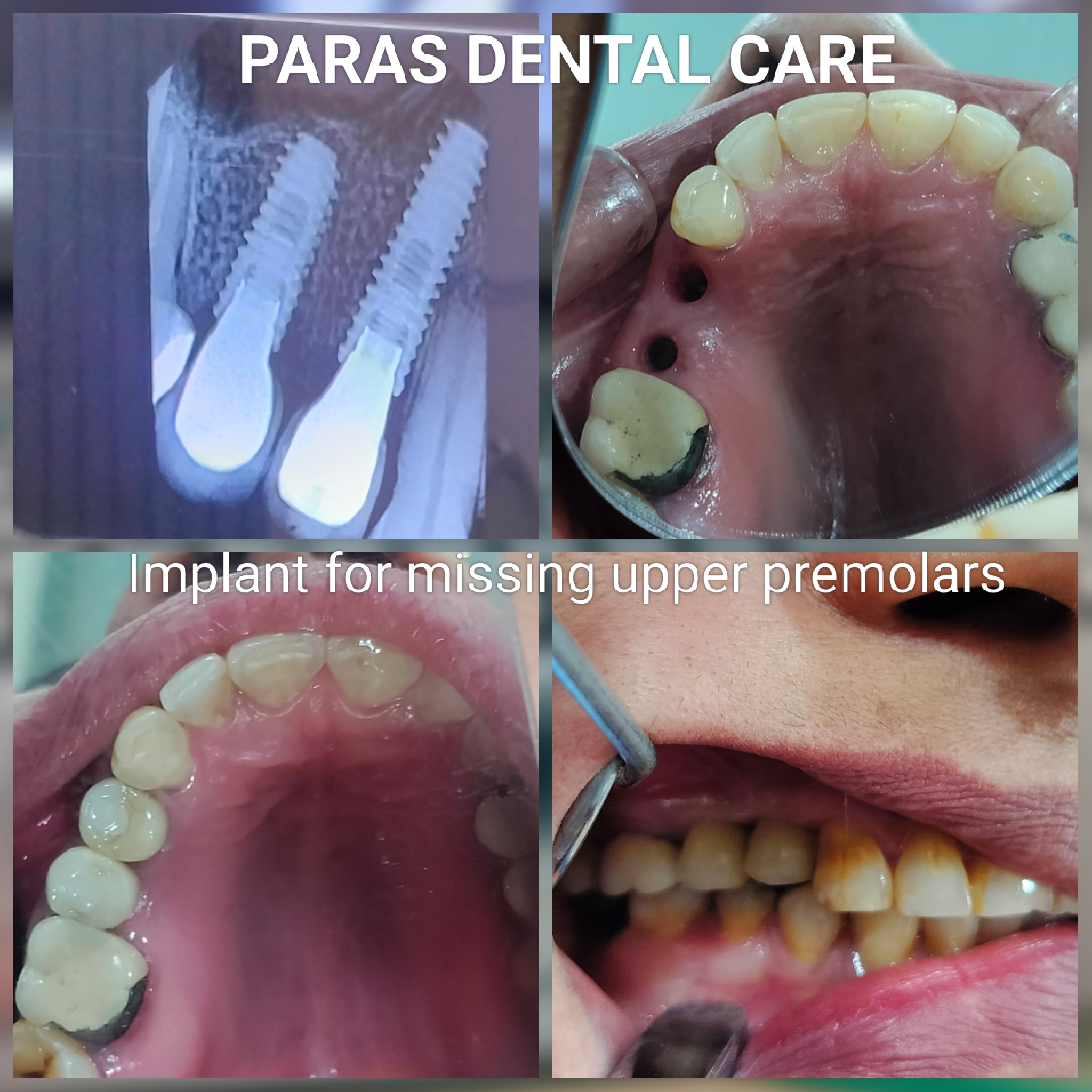 Dental Implants for Missing Teeth main image