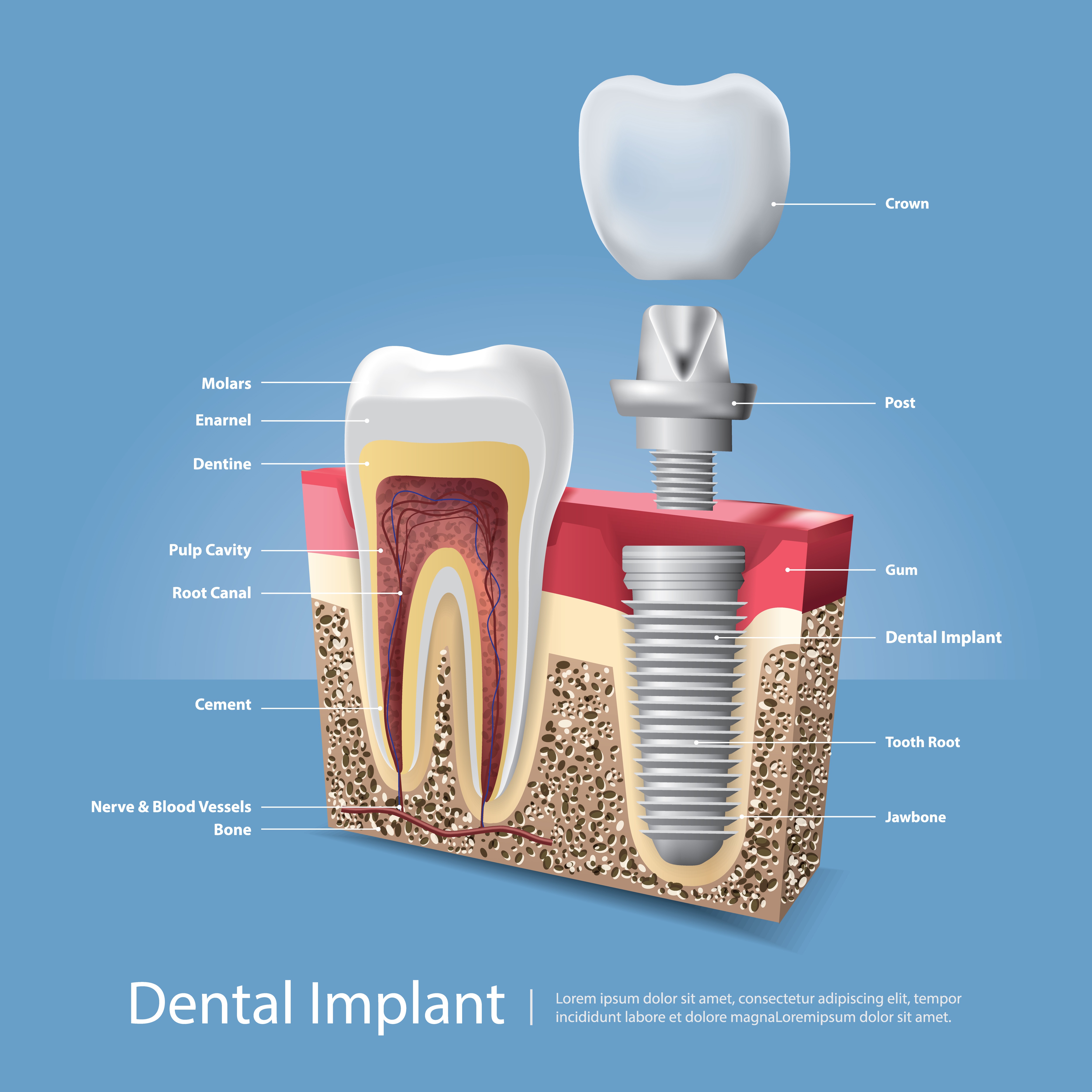 Dental Implants in Nashik – Restore Your Smile with Confidence main image