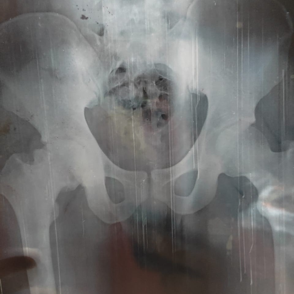 AVN hip and shockwave therapy treatment at Sunshine clinic main image