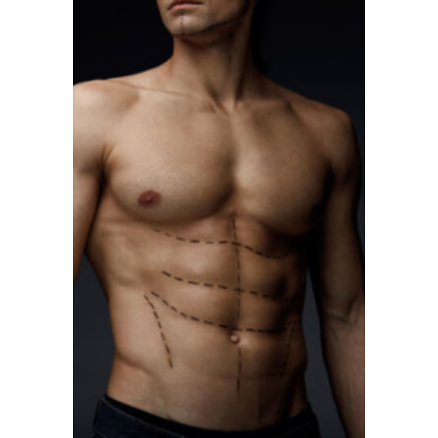 Liposuction in Nungambakkam – Sculpt Your Body Safely and Precisely main image