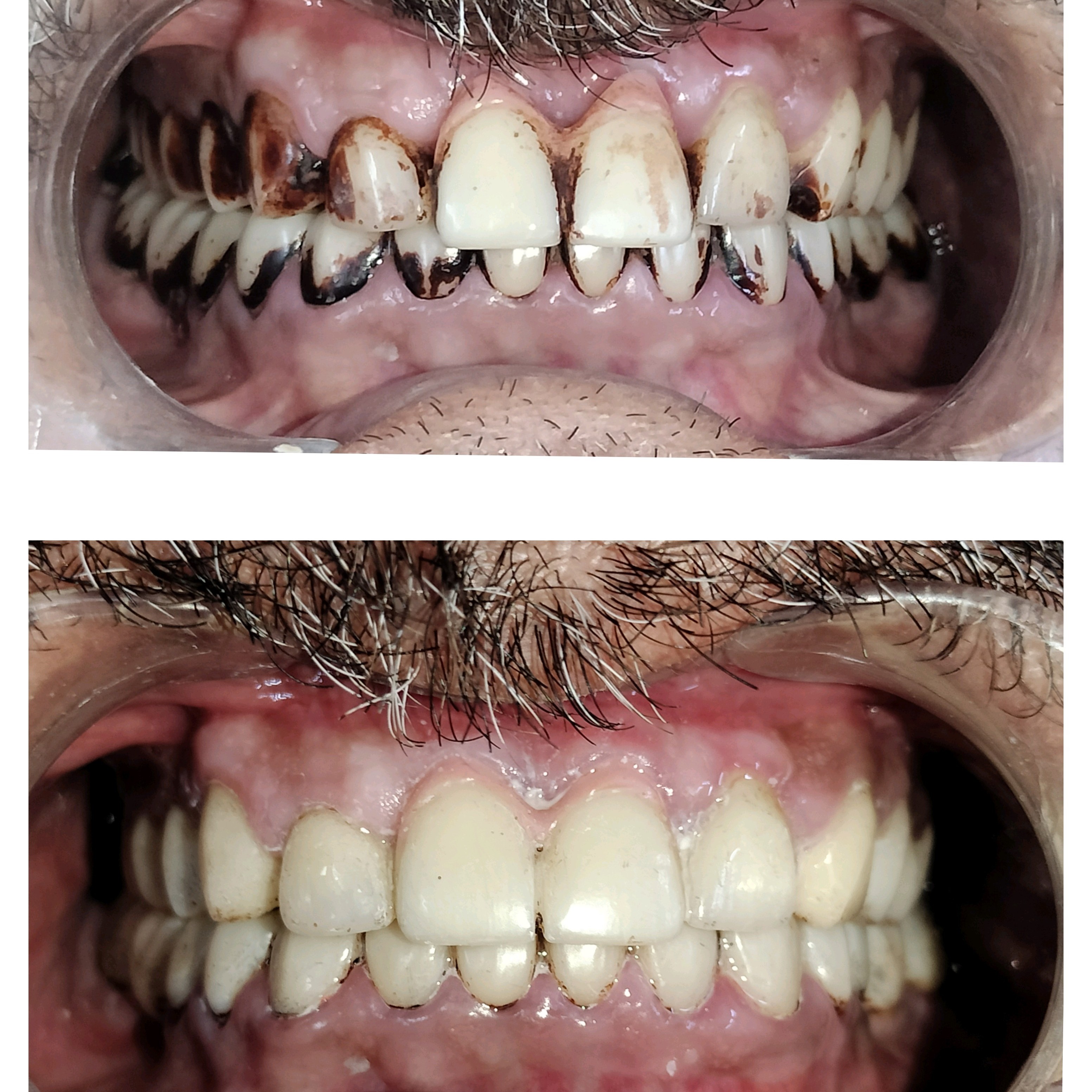 Teeth cleaning in Mira Road main image