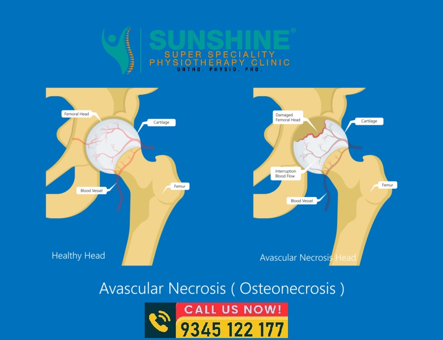 Shockwave Therapy for AVN Hip at Sunshine Clinic main image