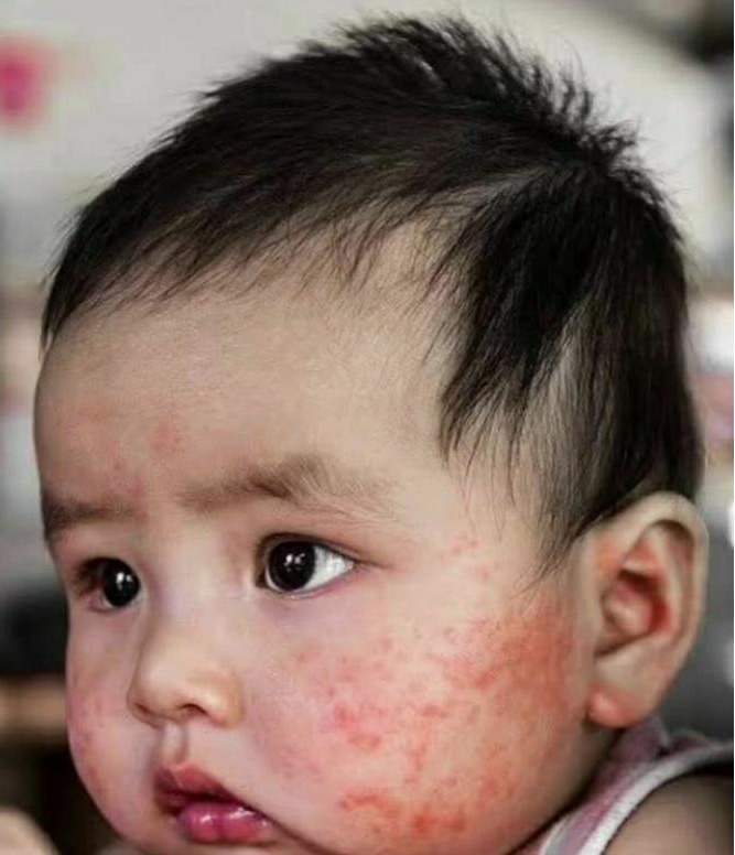 BEST ECZEMA  SKIN CLINIC IN SALEM main image