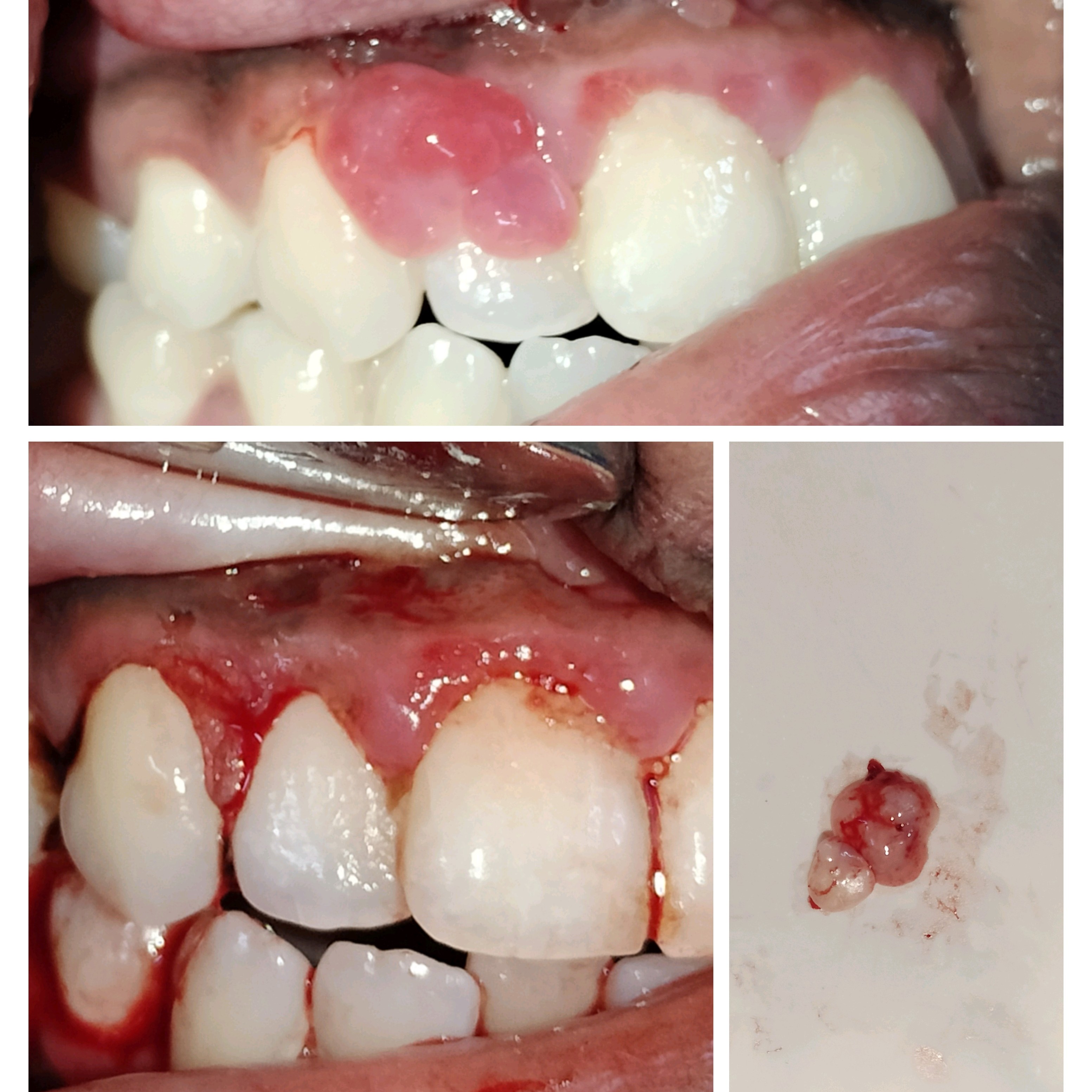 Swelling or Lump removal from Gums main image