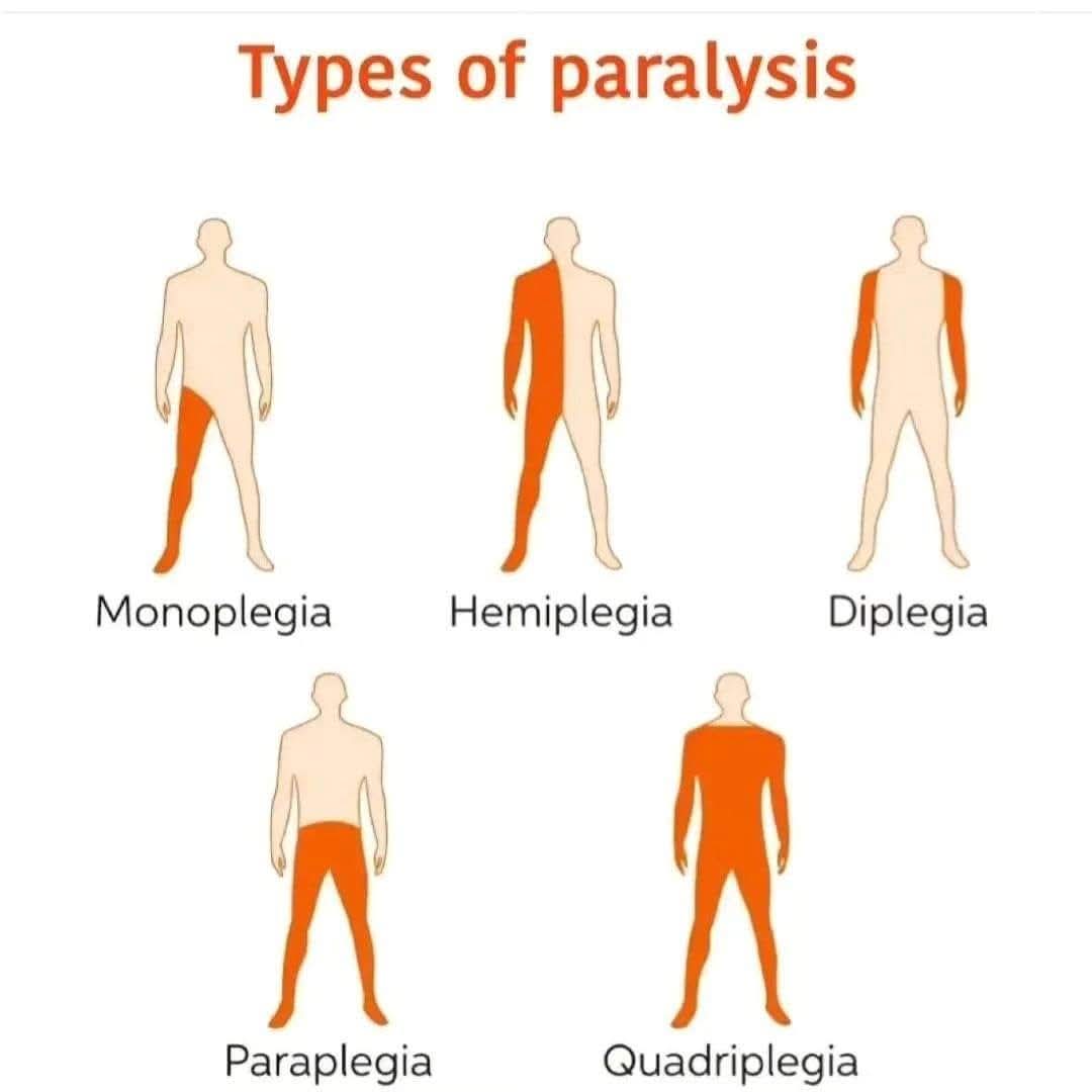 Types of Paralysis and physiotherapy treatment main image