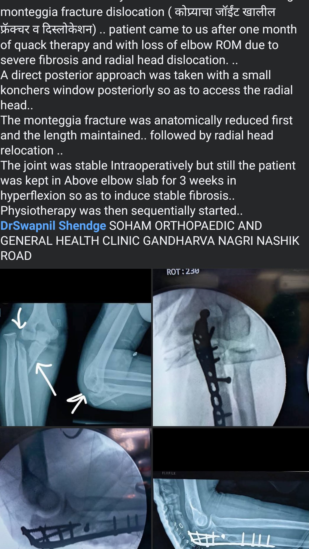 A severe difficult operated case by our surgeon Dr. Swapnil Shendge sir main image