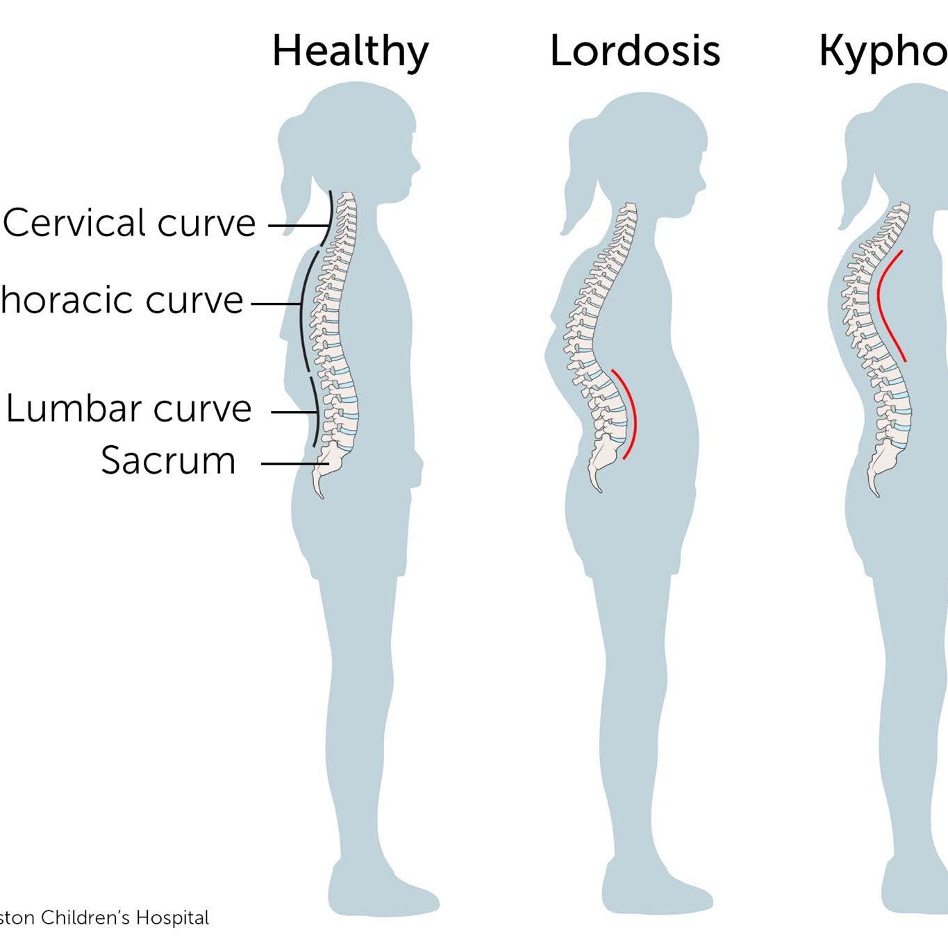 Spinal curvatures refer to the abnormal curves of the spine, which can occur in various parts of the main image