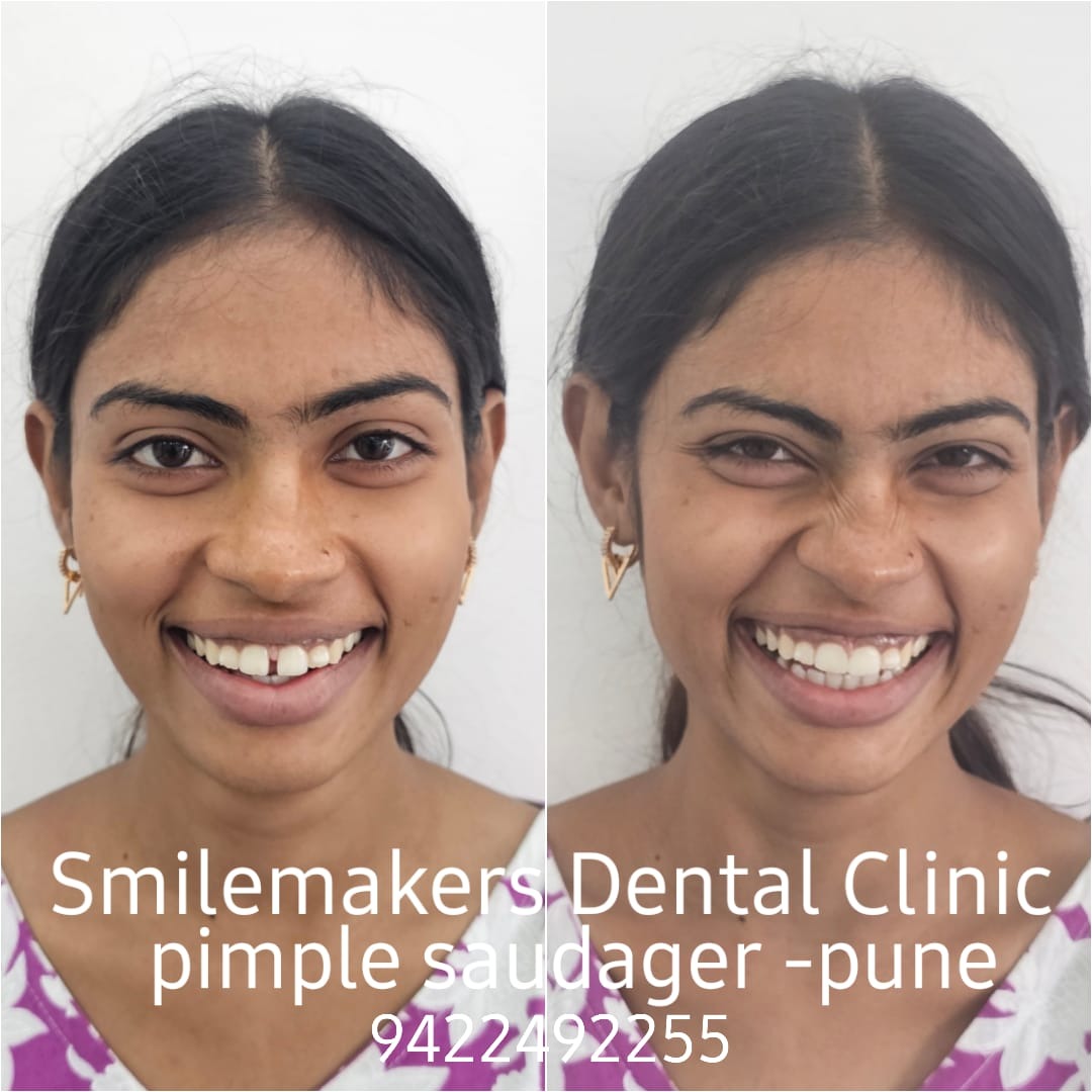 Best Smile makeover clinic in pimple saudagar! Single sitting 100% painless smile makeover in less t... main image