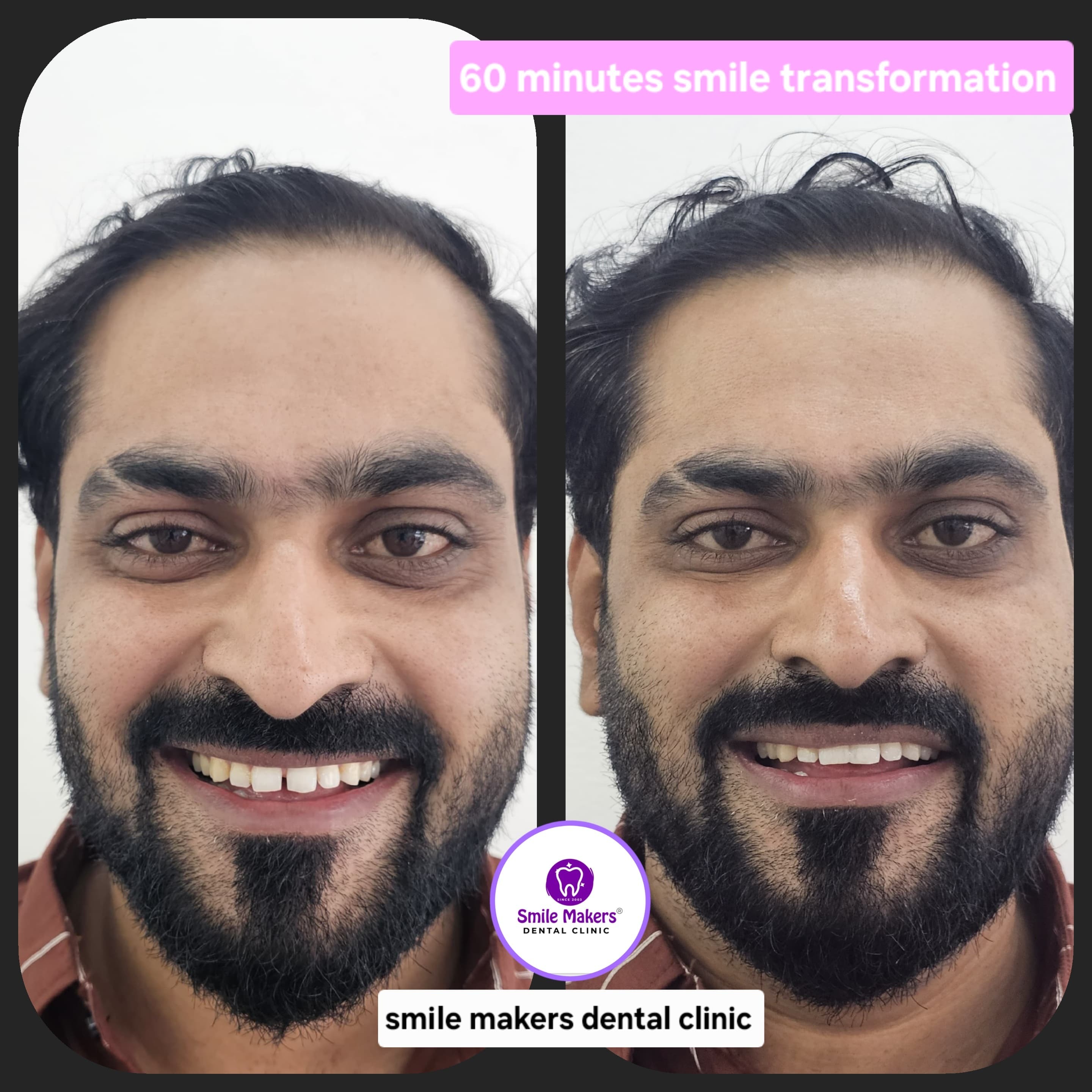 best smile designing clinic in pimple saugadar! 60 minutes life changing smile transformation 🦷🦷on... main image