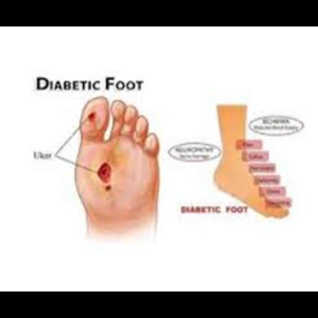 Diabetic Foot Ulcer Management in Bangalore – Protecting Health Through Specialized Care main image