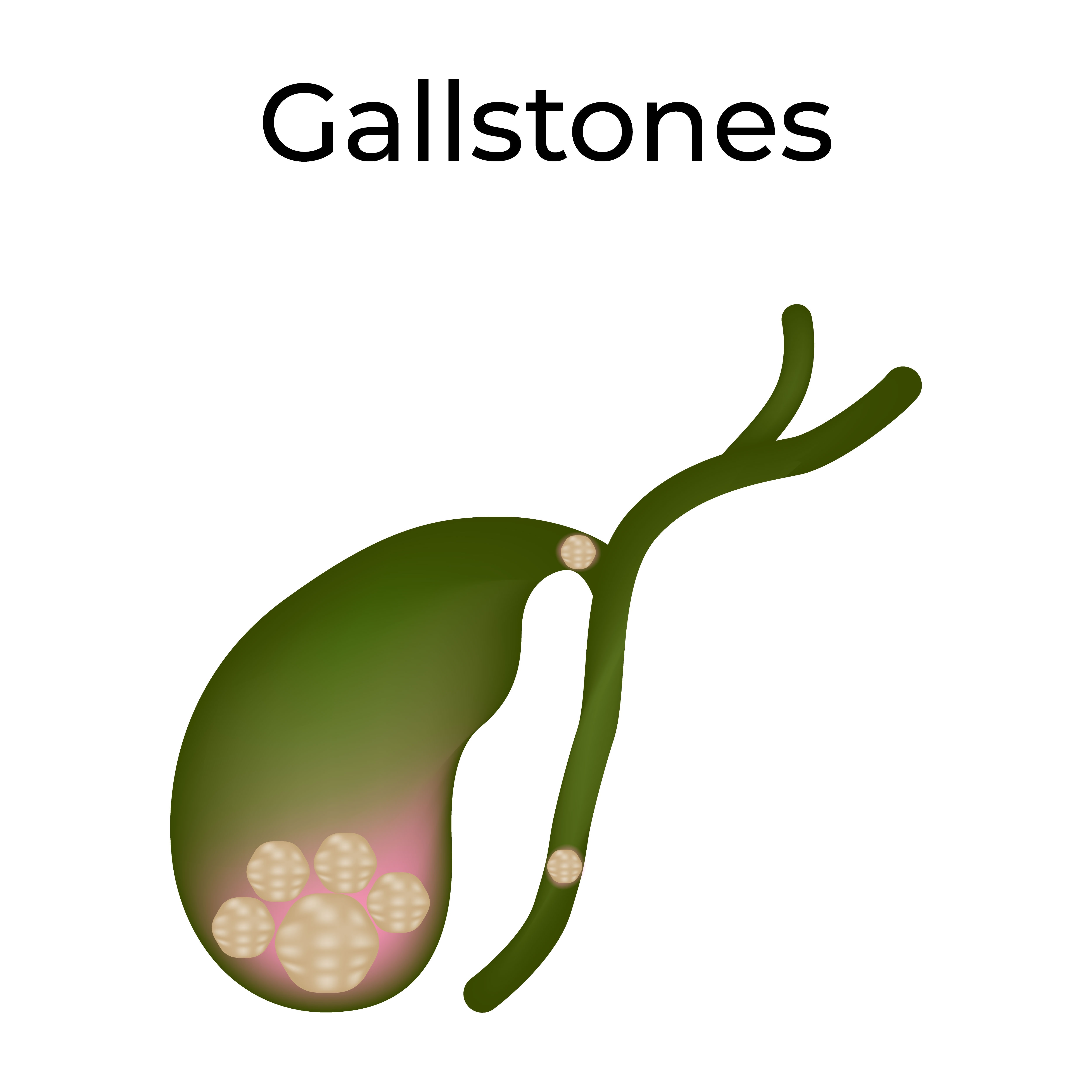 Gallbladder Stone Treatment Hospital in Pune main image