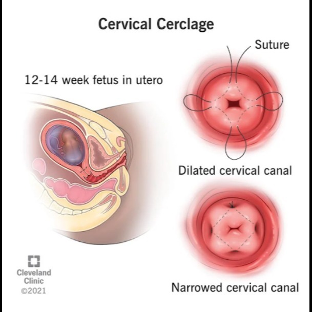 Cervical Cerclage in Nagpur – Supportive Care for High-Risk Pregnancies main image
