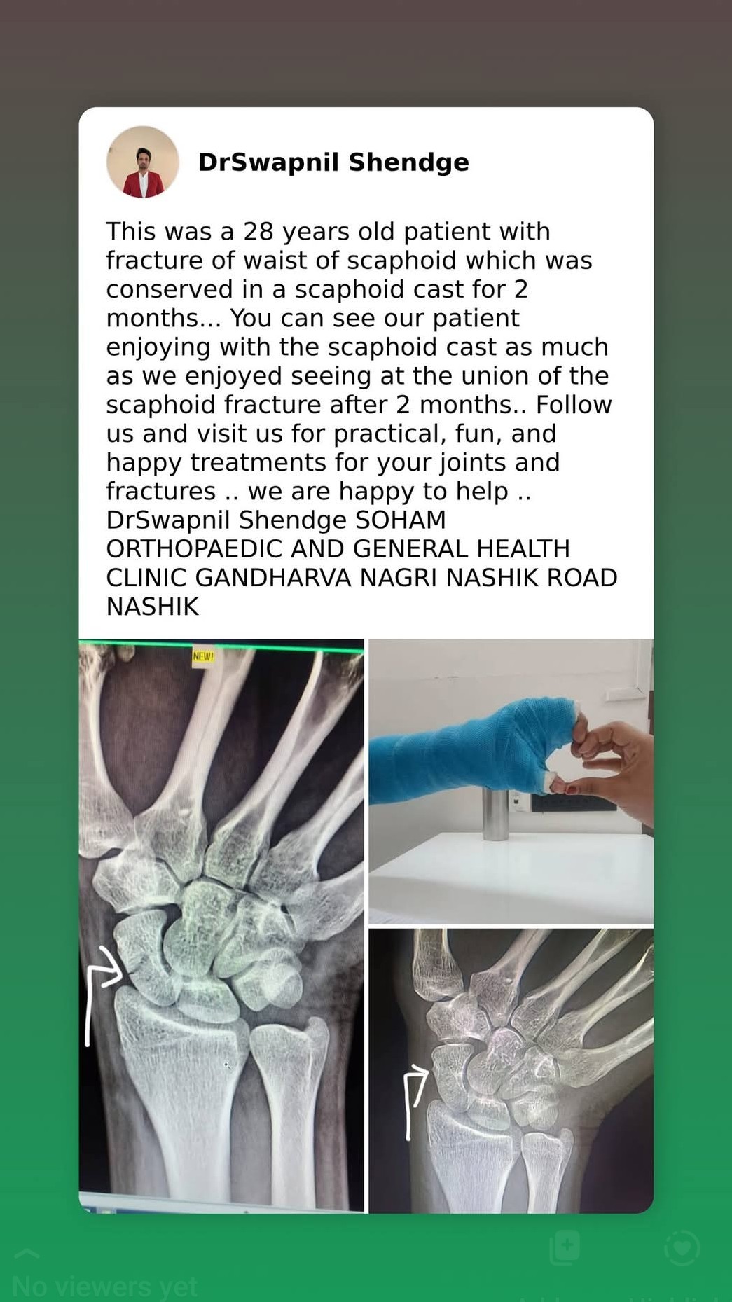 A recent fracture that we treated..  Visit our clinic for your treatment ..  main image