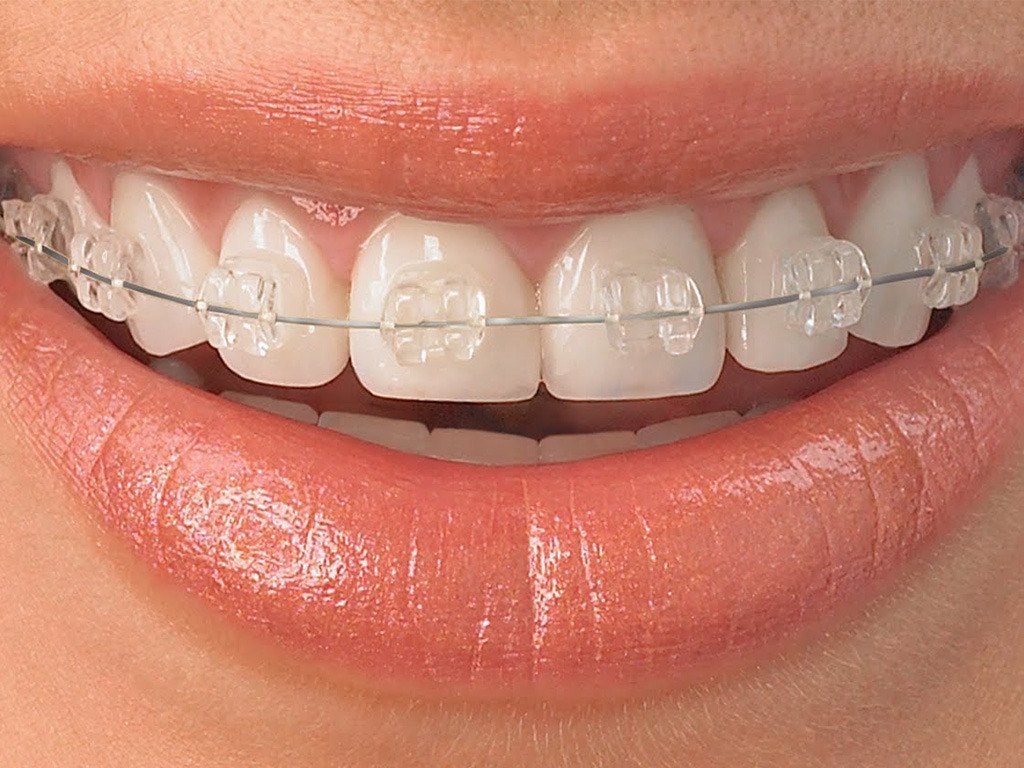 Invisible Braces in Nashik – Straighten Your Teeth Discreetly main image